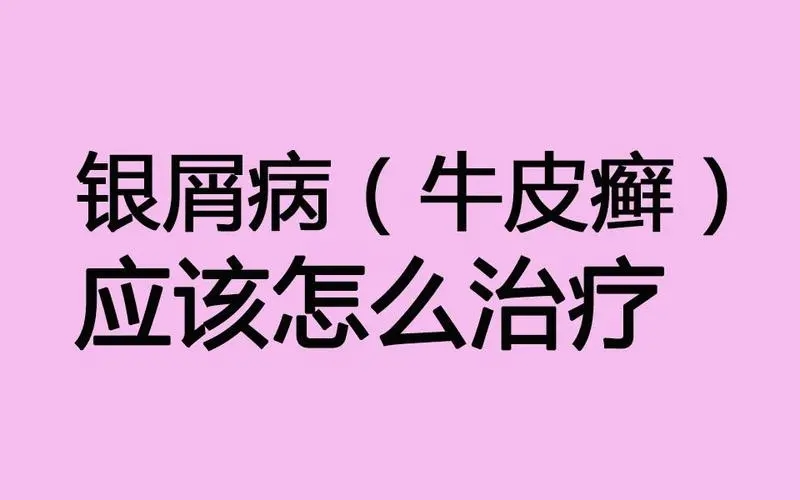 牛皮癣治疗存在哪些误区