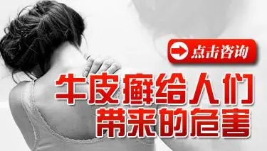 牛皮癣的危害是什么